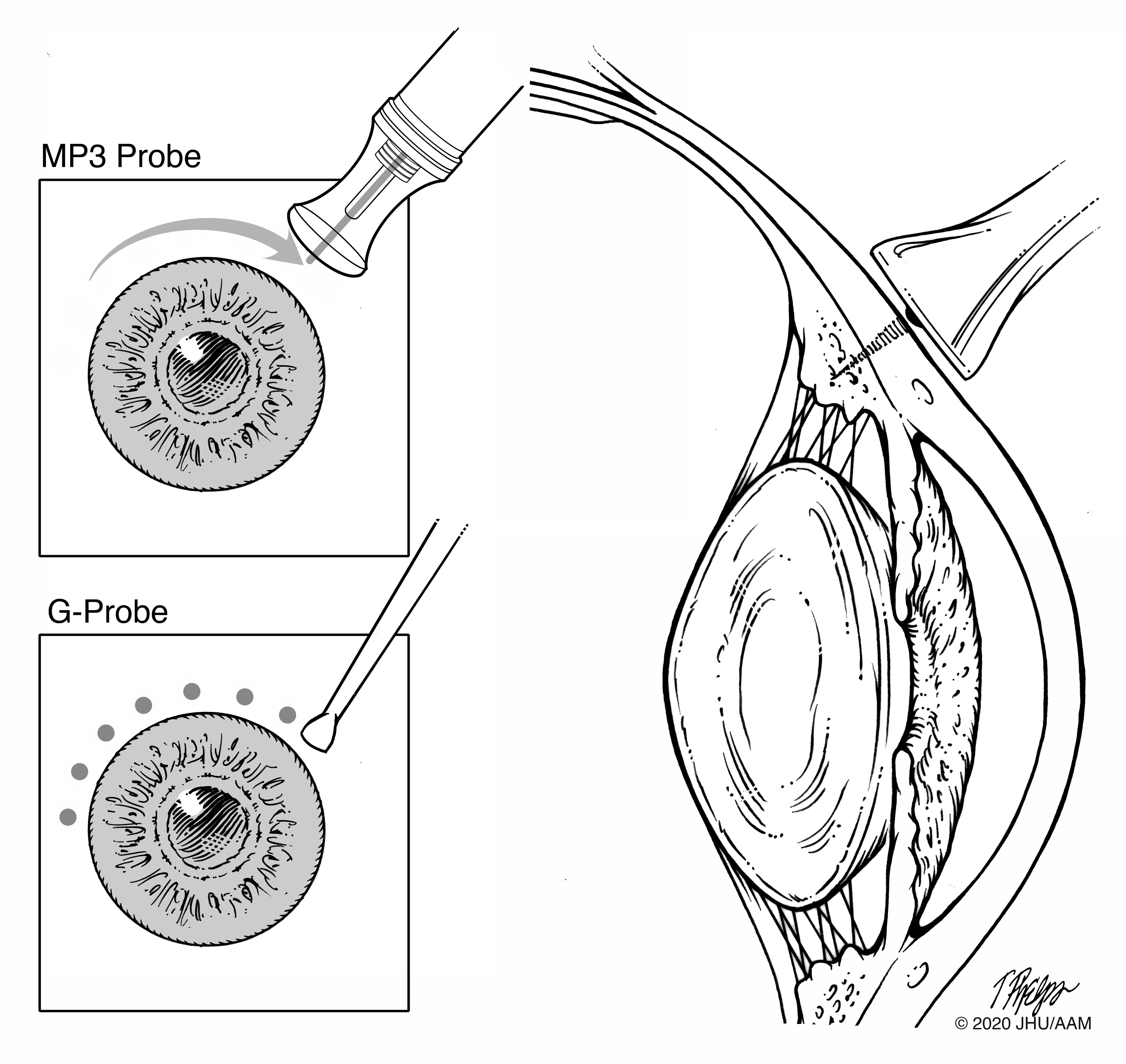 Laser cyclophotocoagulation