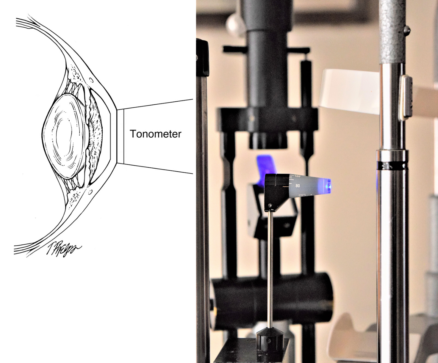 The Importance of IOP & Tonometry Testing
