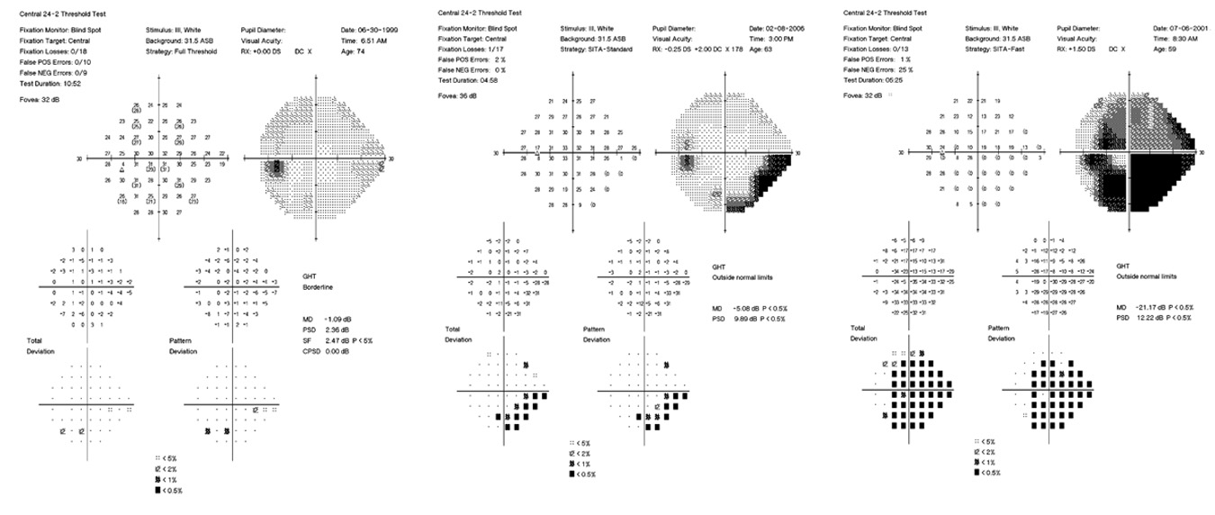 Breaking Down Visual Fields In Glaucoma