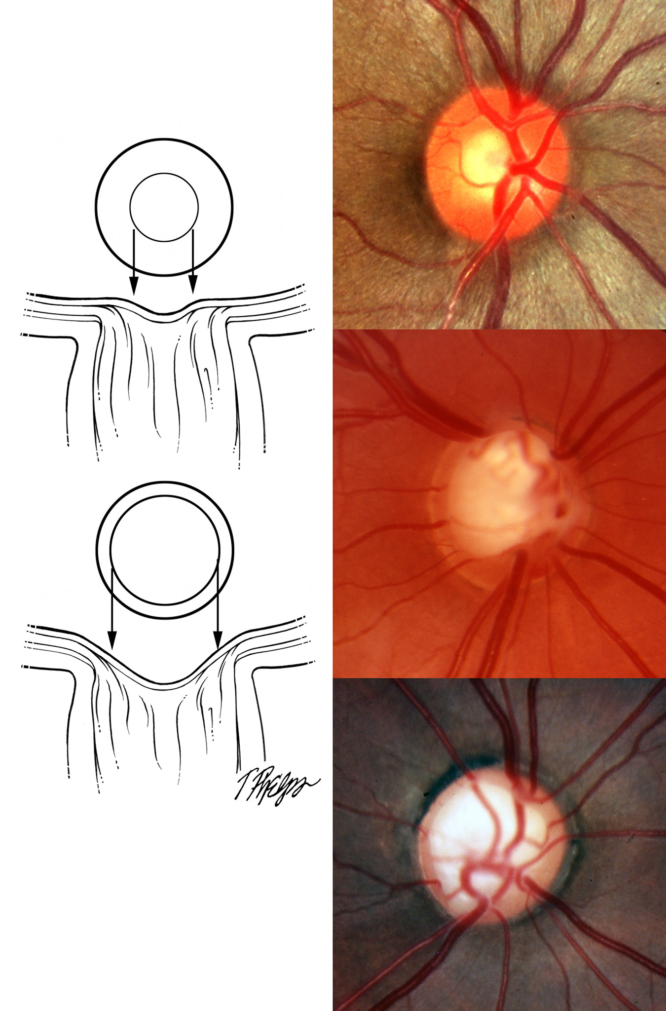 Optic nerve exam