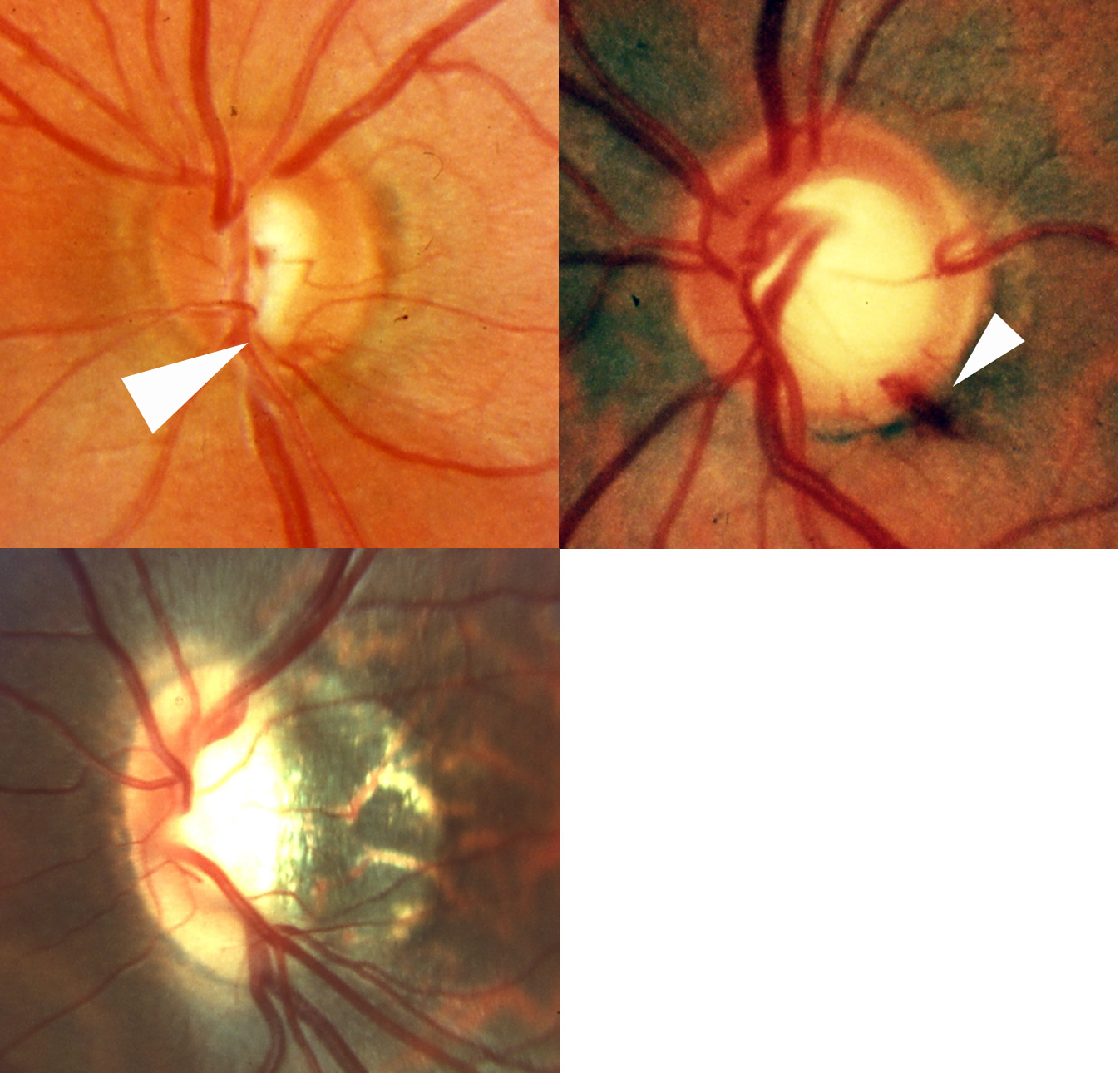 Optic nerve photographs