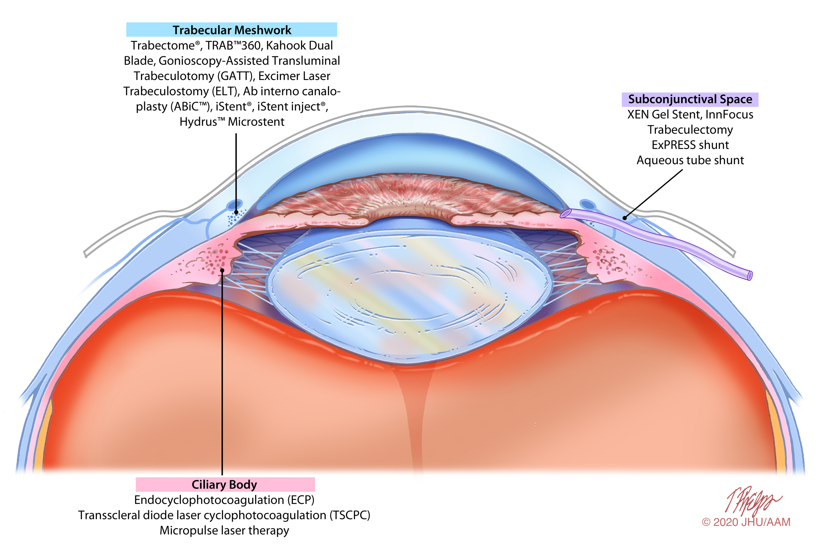 Minimally Invasive Glaucoma Procedures