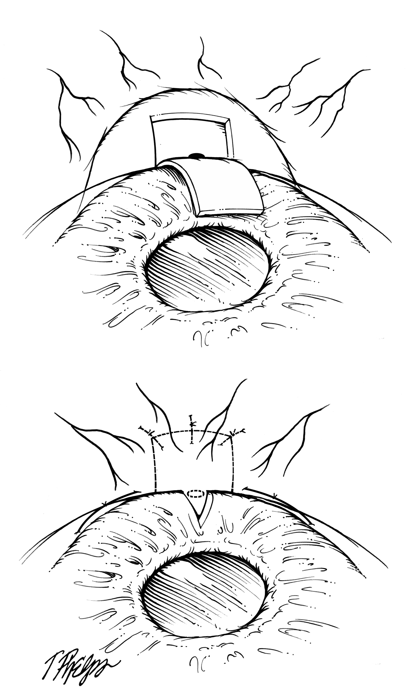 Trabeculectomy Diagram